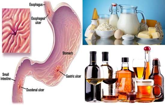 List of Foods to Avoid If You Have Stomach Ulcers.