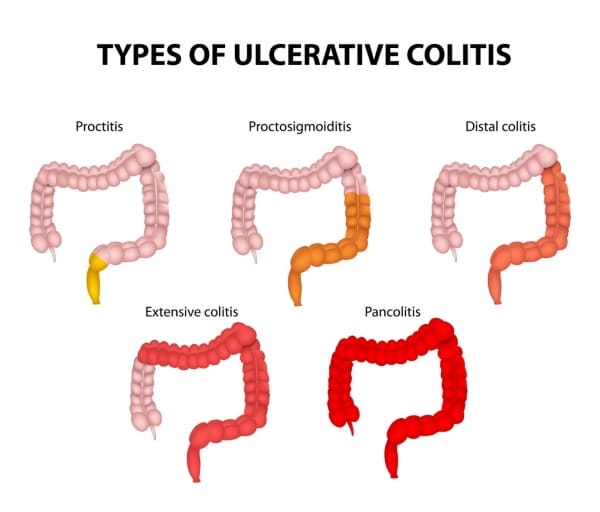 Living with ulcerative colitis
