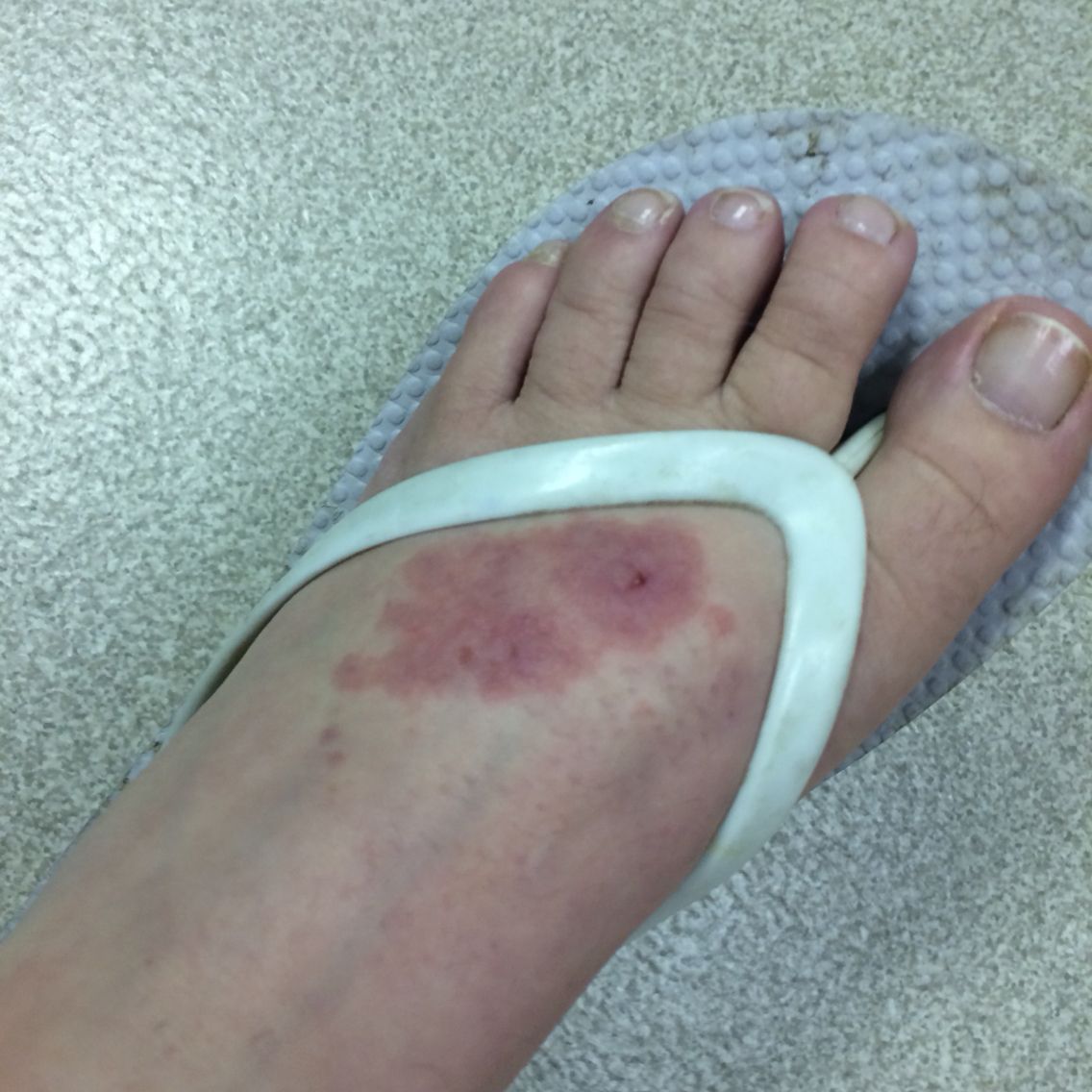 Lupus rash on foot