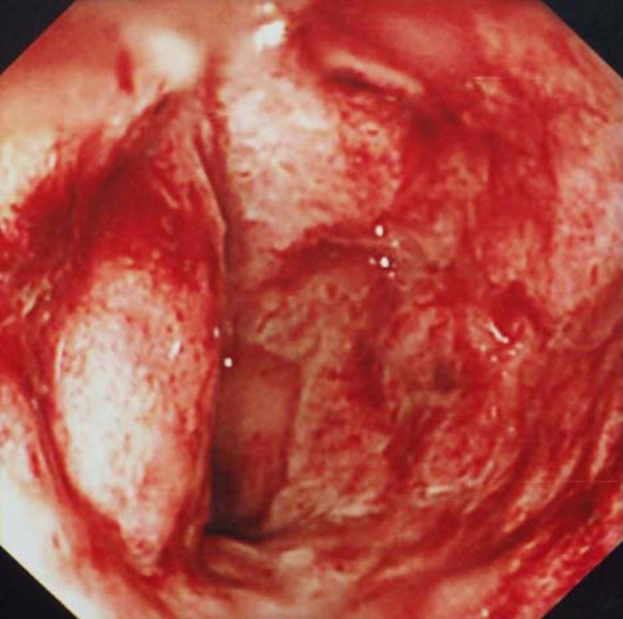 Lymphogranuloma venereum and HIV infection: misdiagnosed as Crohn
