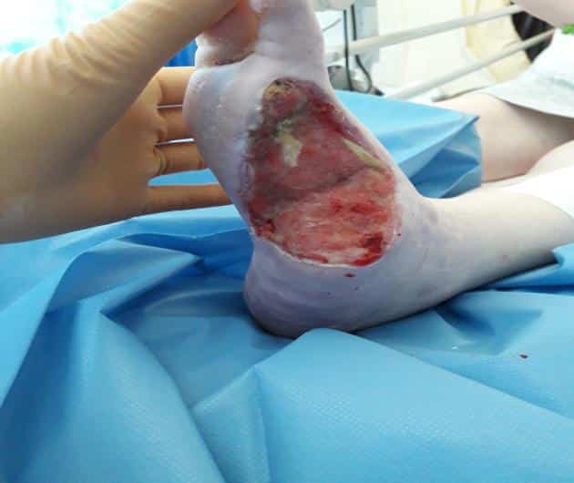 Management of a patient with an infected Diabetic Foot Ulcer