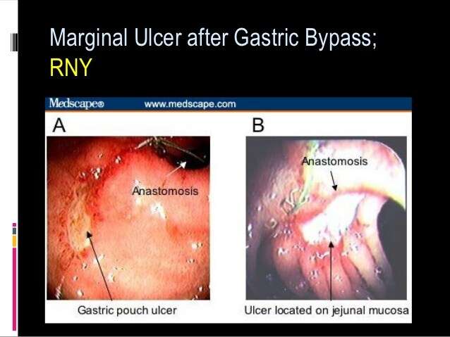 Marginal ulcer gastric bypass