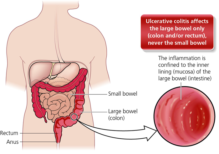 May 19 Is World IBD Day: What Is Inflammatory Bowel Disease?