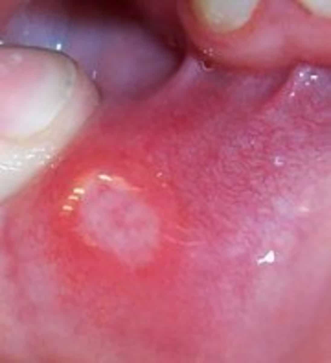 Medicine, Treatment and Prevention of Mouth Ulcers