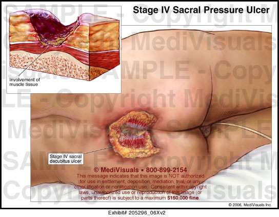 Medivisuals Stage IV Sacral Pressure Ulcer Medical ...