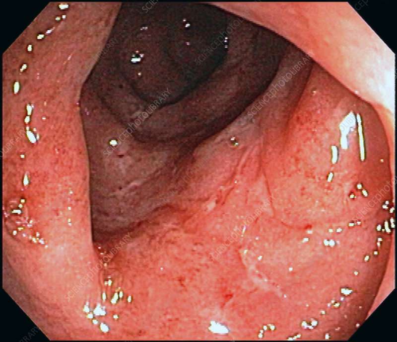 Moderate Ulcerative Colitis