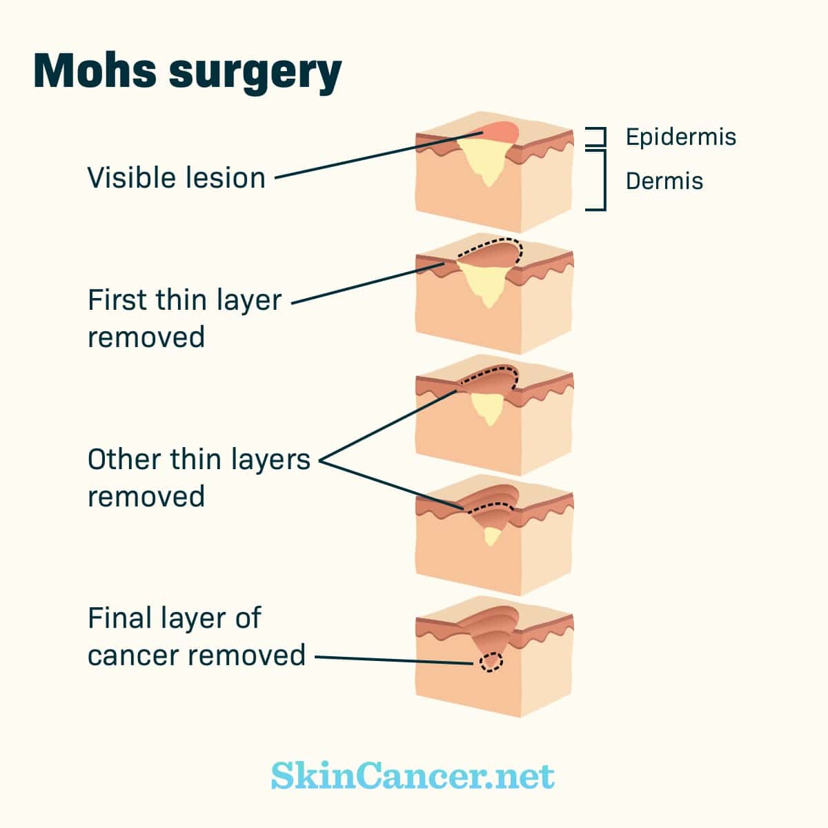 Mohs Surgery As A Skin Cancer Treatment Option Skincancer Net