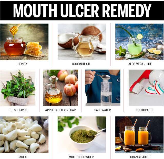 Mouth Ulcer Remedy At Home