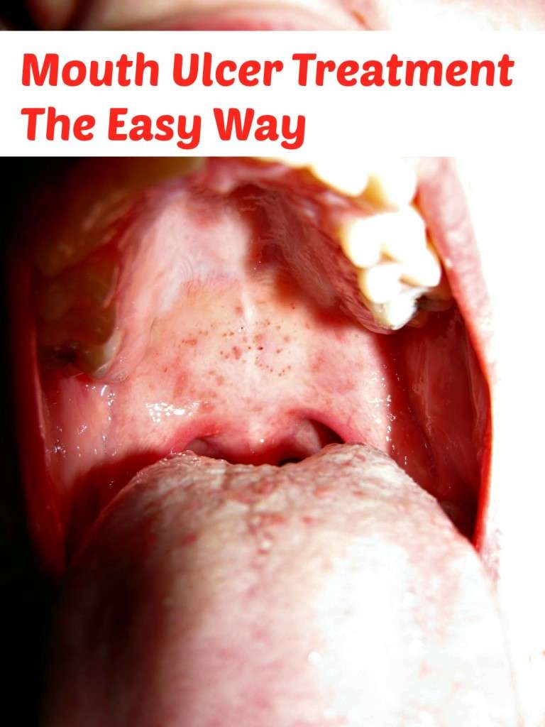 Mouth Ulcer Treatment The Easy Way