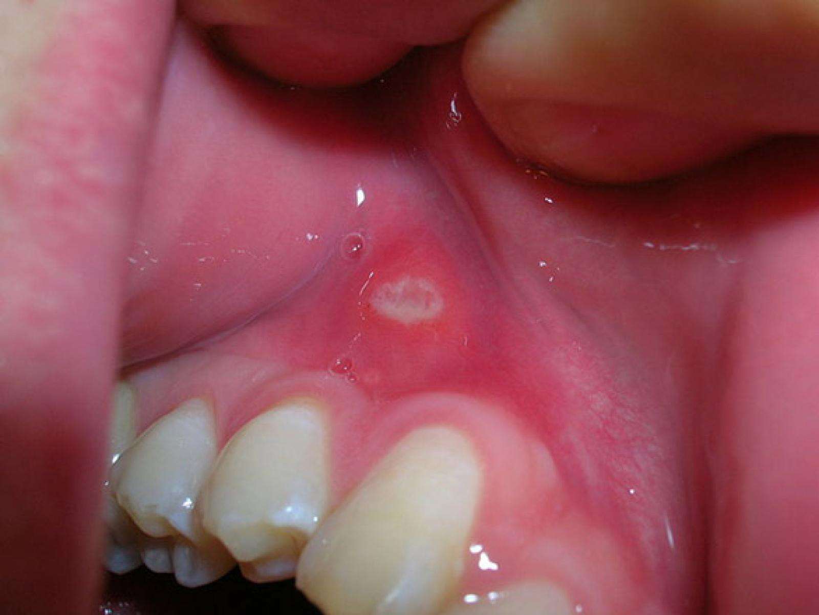 Mouth Ulcers