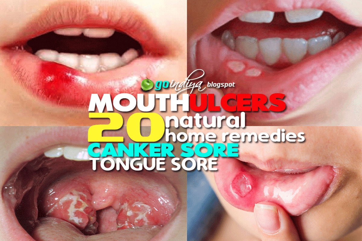 Mouth Ulcers (Canker sore/Tongue Sore)