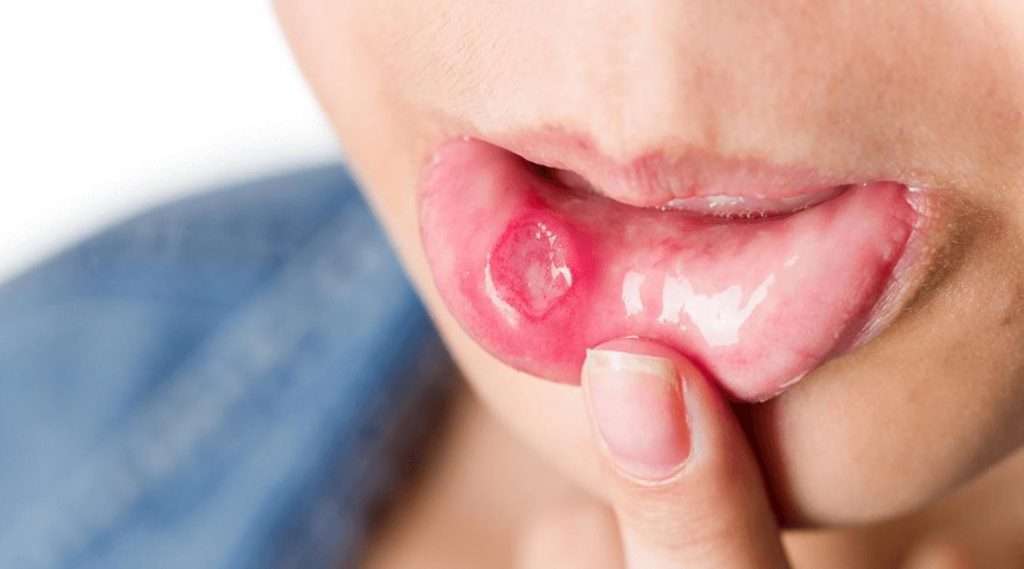 Mouth Ulcers Not Letting You Enjoy Your Food? Learn How To ...