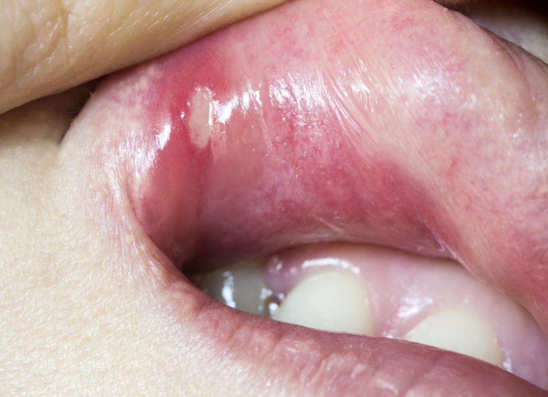 Mouth ulcers: Types, causes, symptoms, and treatment