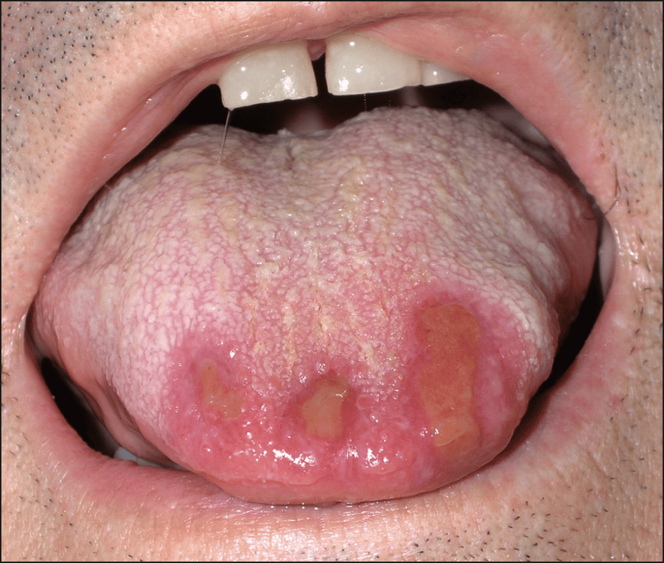 Mucous Membrane Ulcers in an Immunocompromised PatientQuiz Case