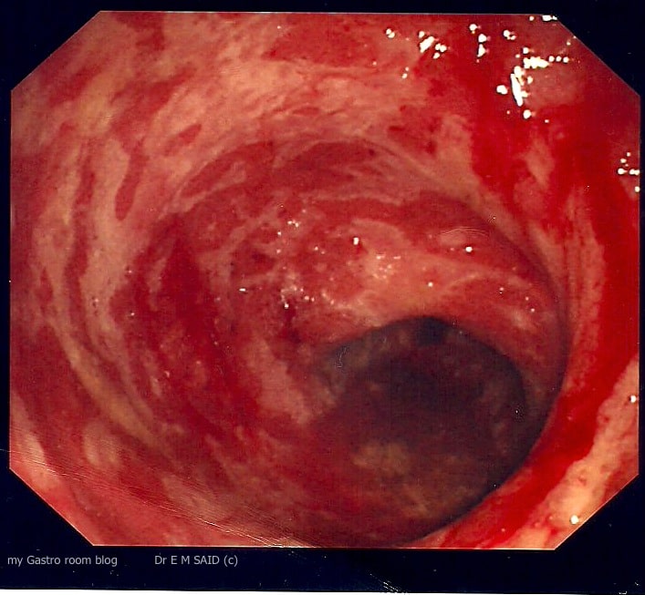 My Gastro Room: Ulcerative Colitis