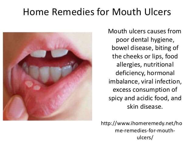 Natural Home Remedies for Mouth Ulcers