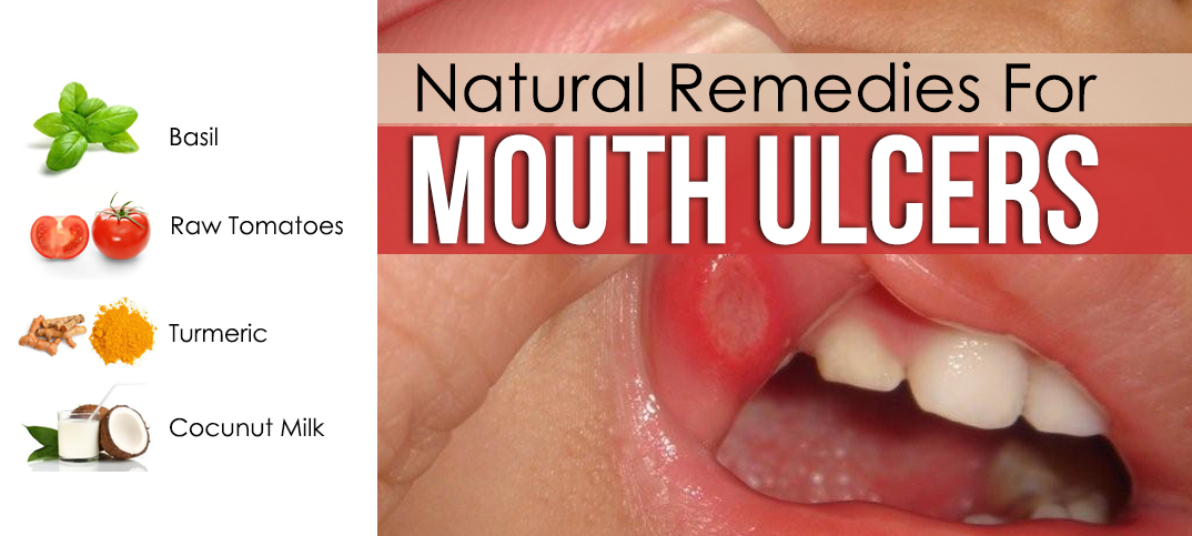 Natural Remedy For Mouth Ulcer
