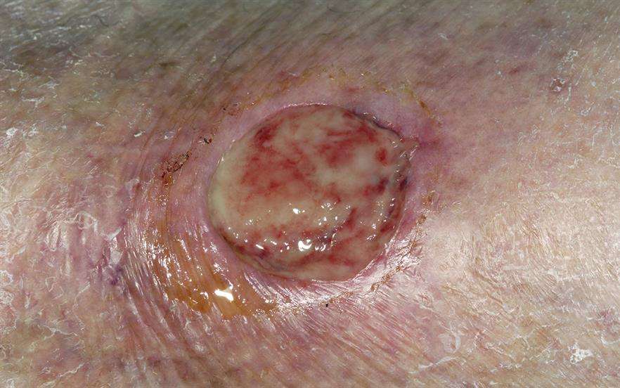 New antibiotic guidance for leg ulcer infection