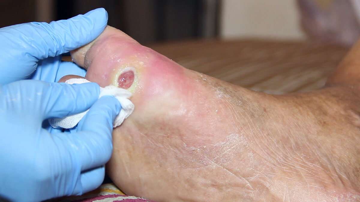 New Treatment Shows Promising Results in Patients with Diabetic Foot ...