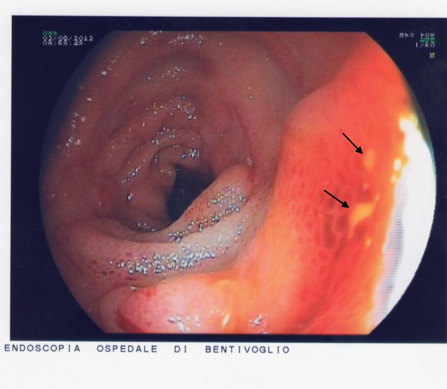 Obstruction of the small bowel due to initial Crohn\