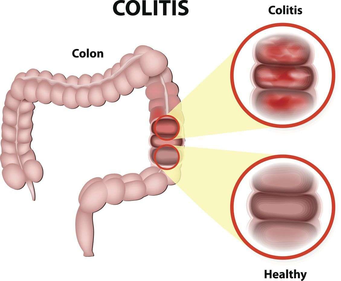 Obwohl die chronisch entzündliche Darmerkrankung Colitis ulcerosa nicht ...