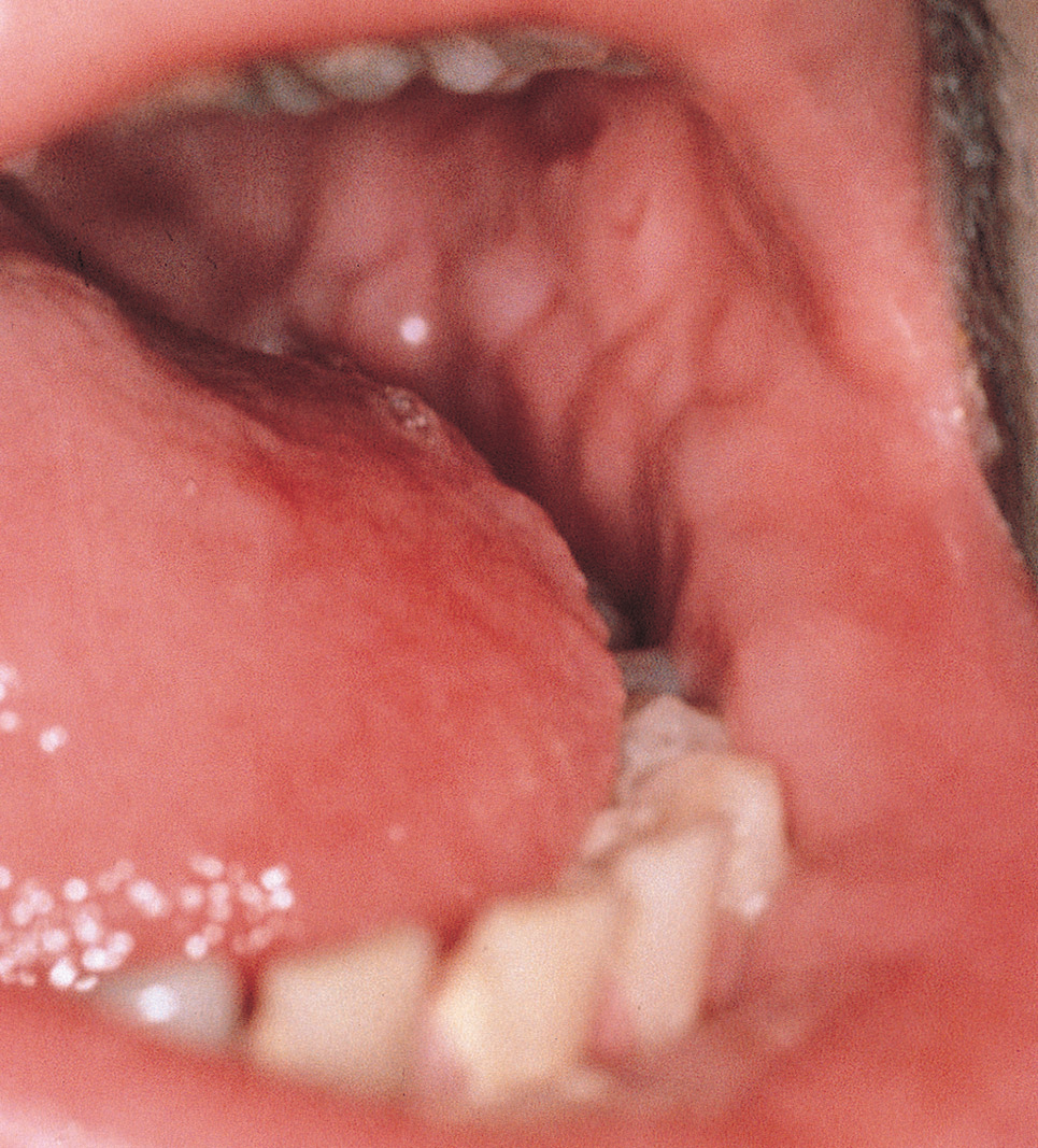 Oral Crohn Disease: Clinical Characteristics and Long