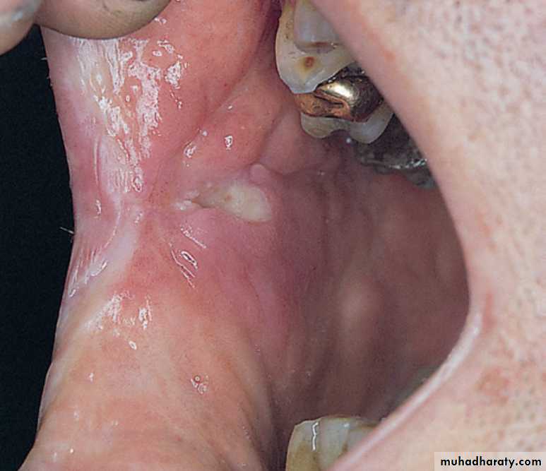 Oral ulceration pptx