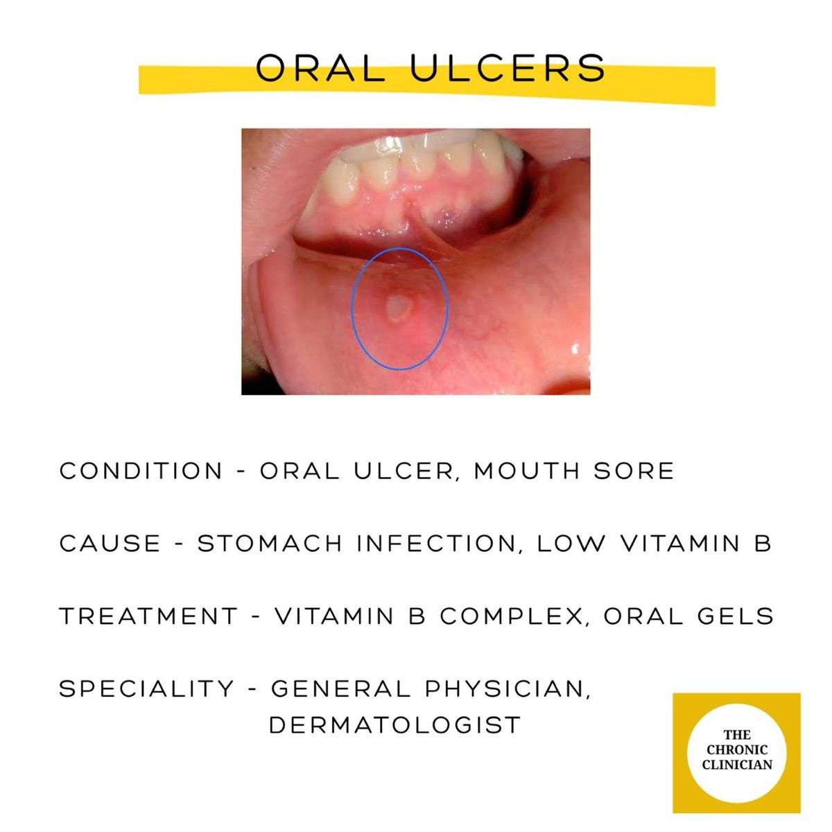 Oral ulcers
