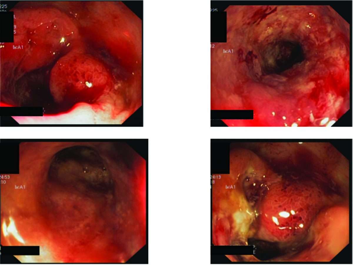 P190 Colonic neuroendocrine carcinoma in ulcerative colitis: a case report