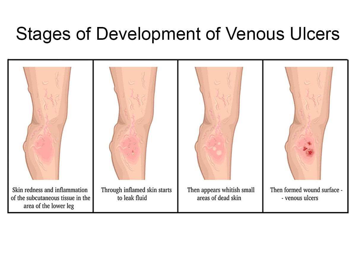 Pain Management for Venous Ulcers