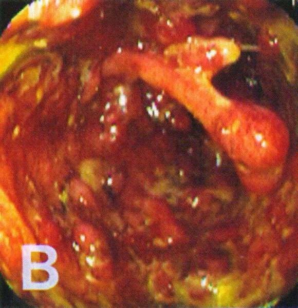 Patchiness of mucosal inflammation in treated ulcerative colitis: A ...