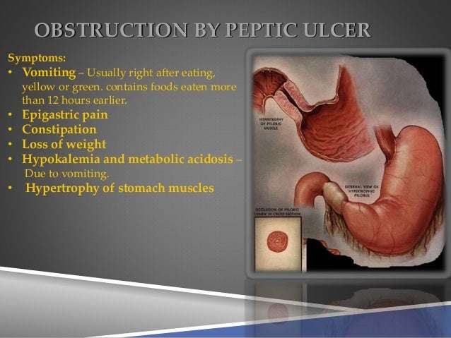Peptic Ulcer Complications