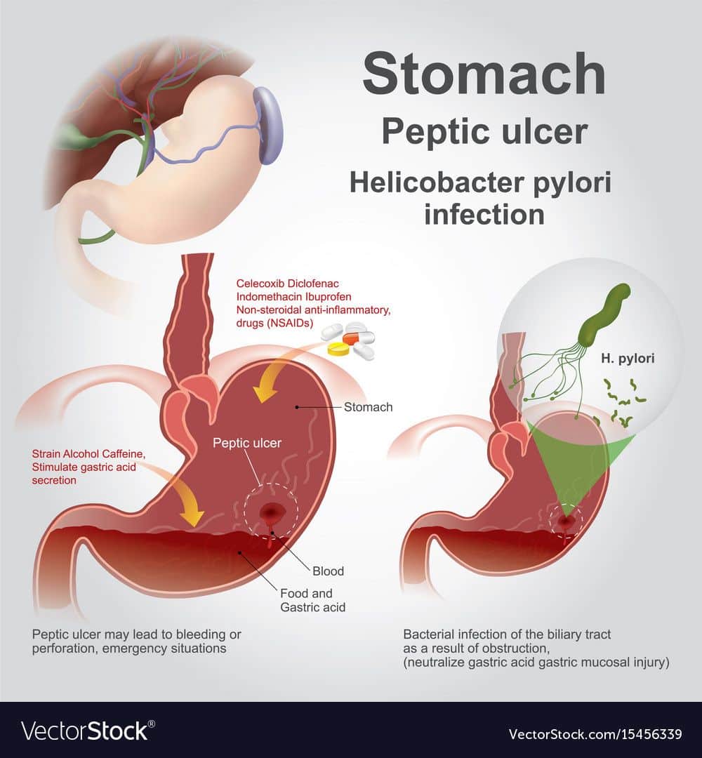 Peptic ulcer disease, also known as a peptic ulcer or stomach ulcer is ...