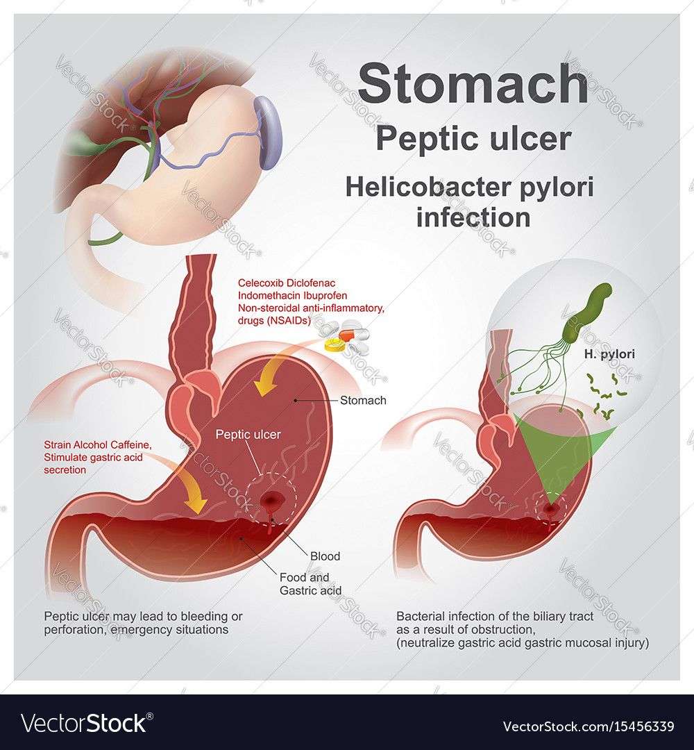 Peptic ulcer disease, also known as a peptic ulcer or ...