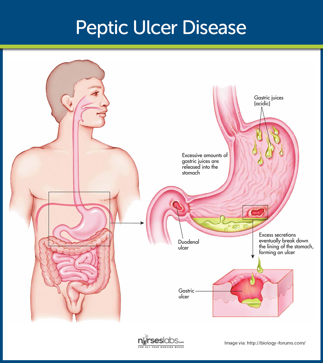 Peptic Ulcer Disease Nursing Care and Management: Study Guide