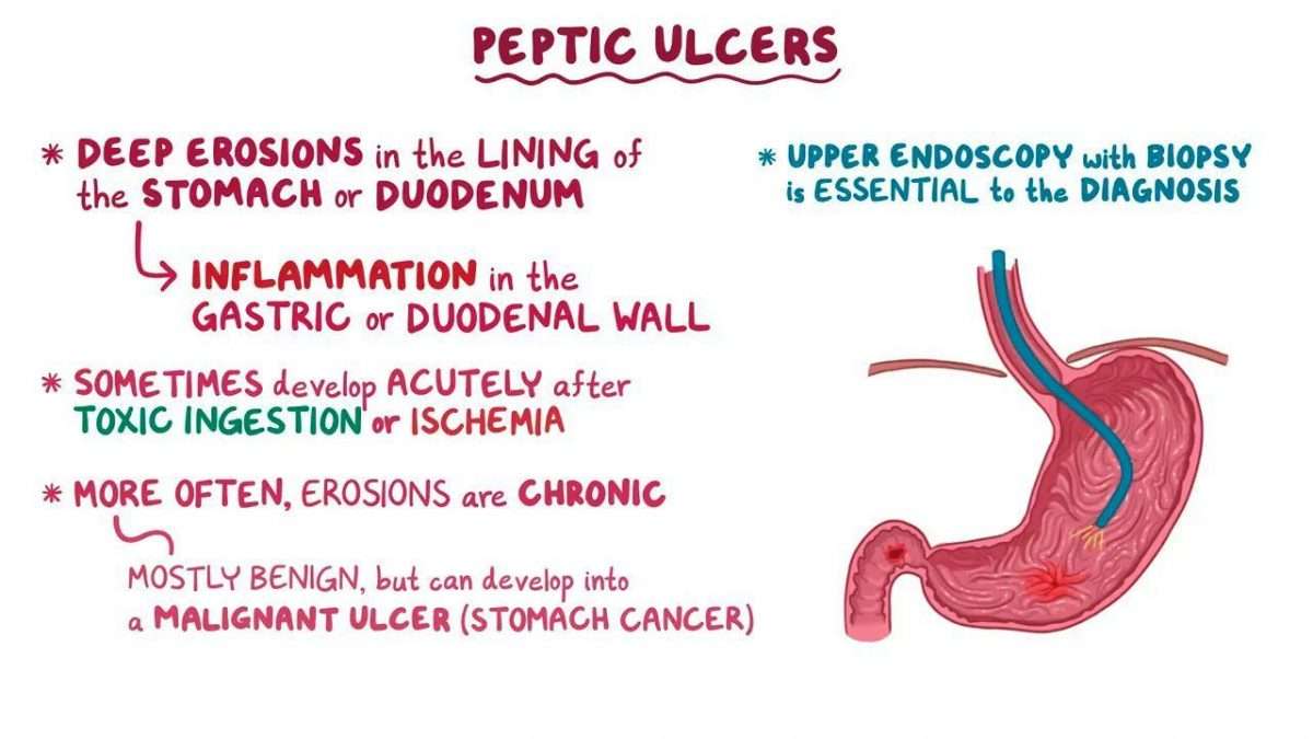Peptic Ulcer Disease Nursing