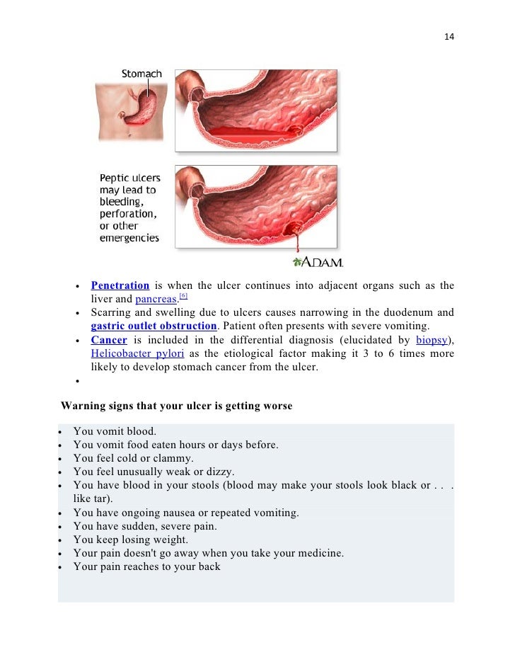peptic ulcer doc
