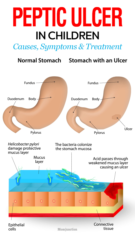 Peptic Ulcer In Children