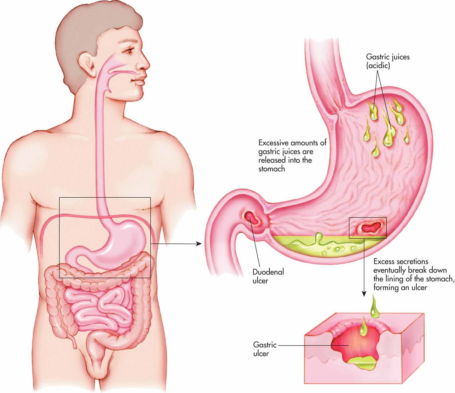 Peptic Ulcer Surgery: The procedure, risks, complications, preparations ...