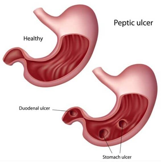 Peptic ulcer: Symptoms,Causes and it