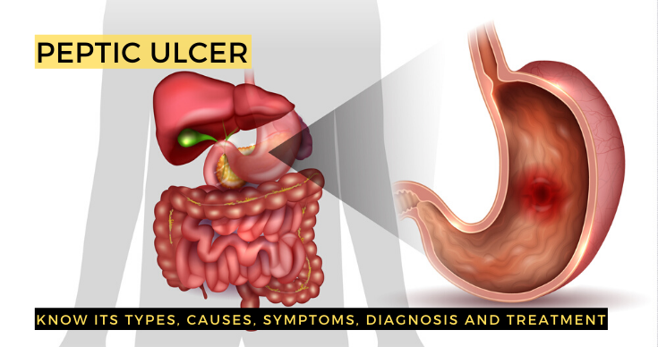 Peptic Ulcer: Types, Causes, Symptoms, Diagnosis And Treatment