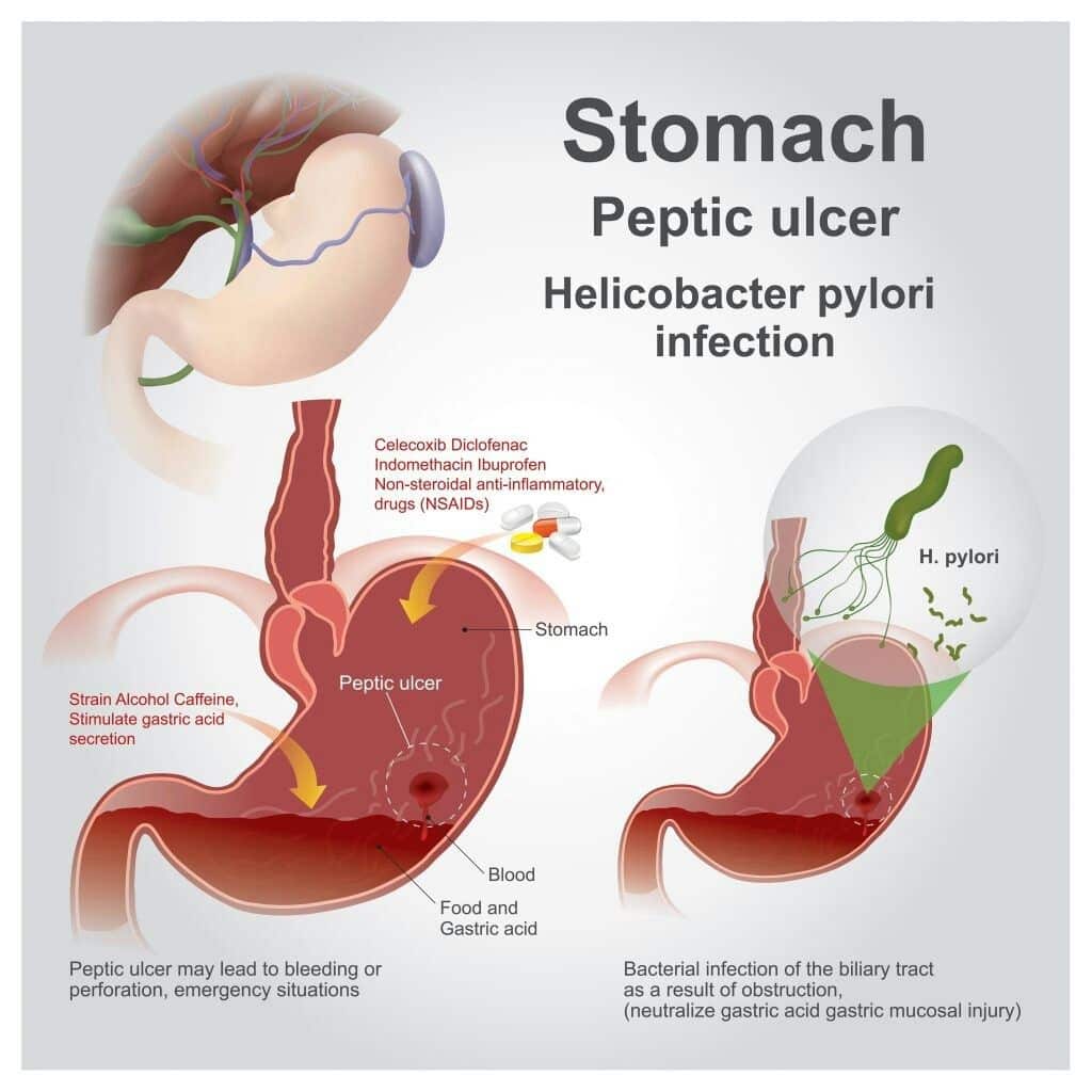 Pin on Gastritis &  Stomach Ulcers &  H Pylori