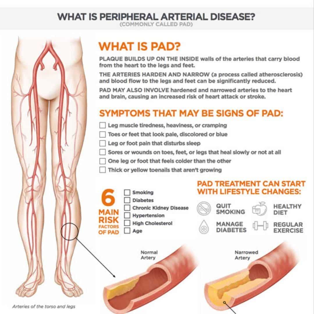 Pin on Peripheral Artery Disease FAQ
