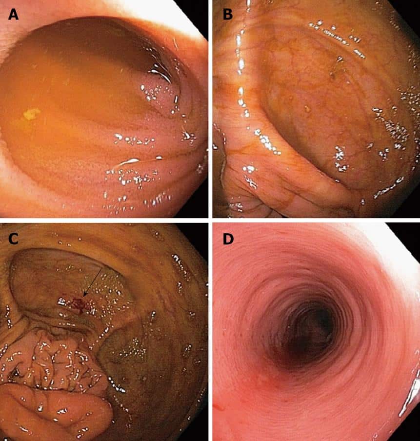 Postcolonoscopy appendicitis in a patient with active ulcerative colitis