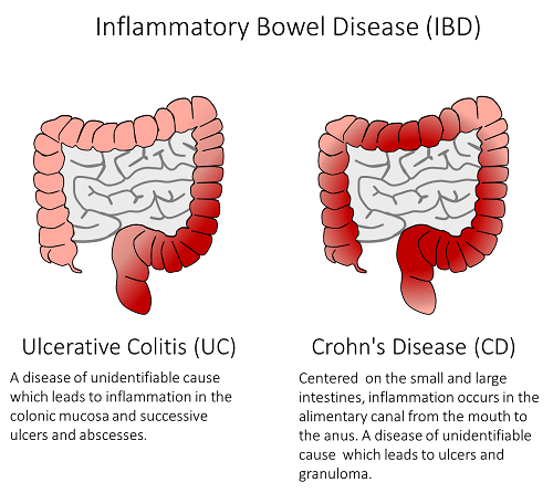 POTENT NEW MECHANISM OF ACTION FOR TREATMENT OF INFLAMMATORY BOWEL ...