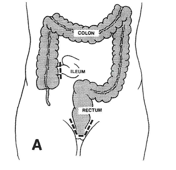 Proctocolectomy