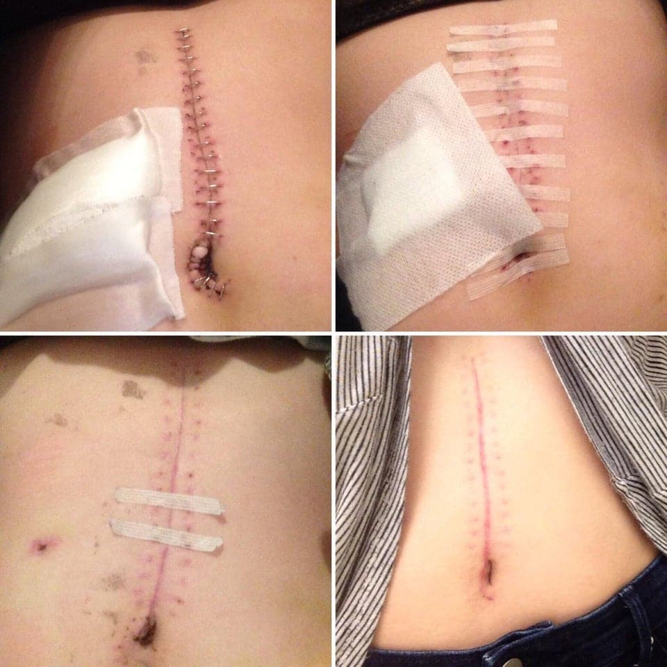 Progress on my scar from an emergency operation to fix a perforated ...