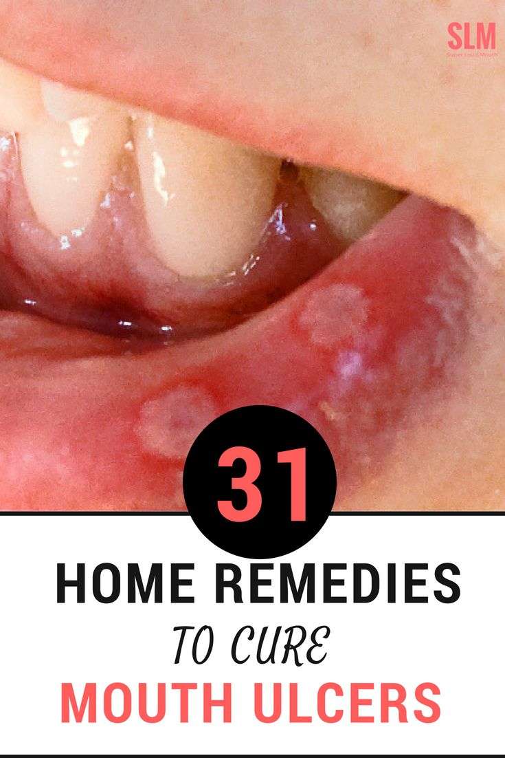 Quick Way To Cure Mouth Ulcer