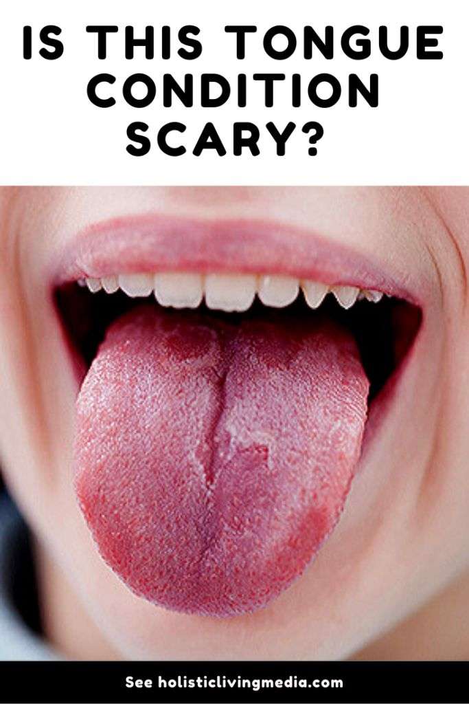 Reasons For Weird Tongue Conditions
