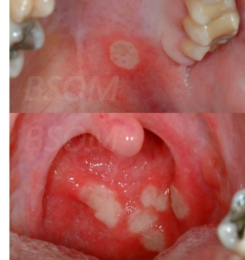 Recurrent Mouth Ulcers  Behcets Disease